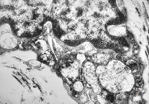 M, 10y. | Coffin-Lowry syndrome - skin